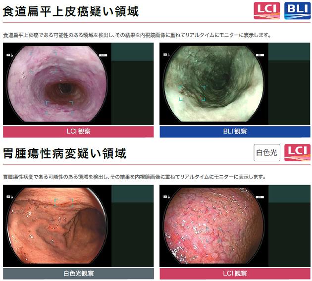 次世代内視鏡システム 食道扁平上皮癌疑い領域、胃腫瘍性病変疑い領域